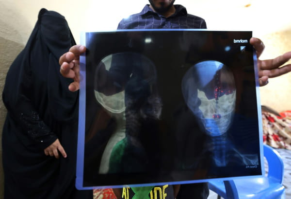 In Iraq, stray bullets mutilate bodies every day