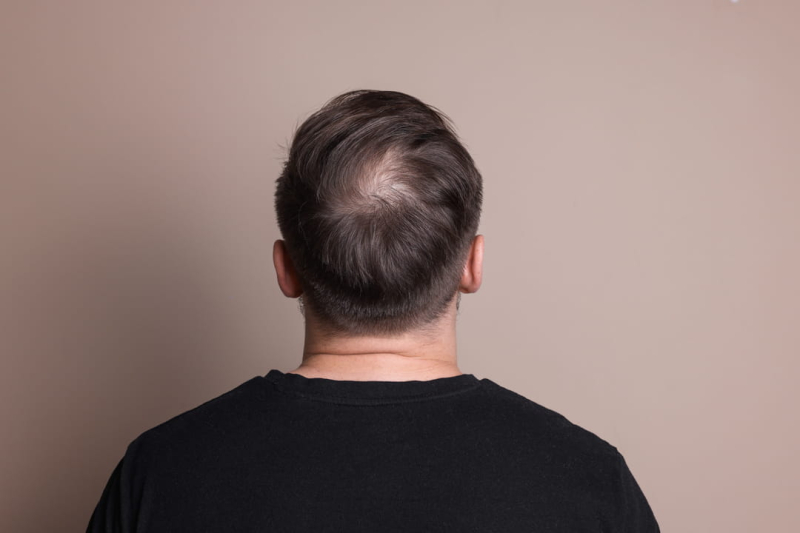 This Hair Loss Treatment for Men Works Better Than Others