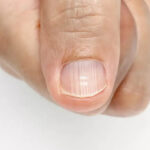 What Ridged Nails Say About Health and Body Functioning