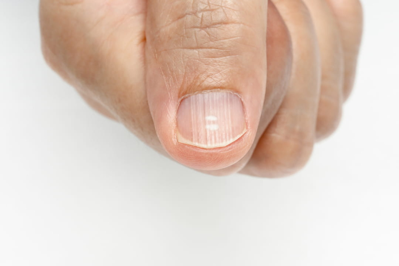 What Ridged Nails Say About Health and Body Functioning